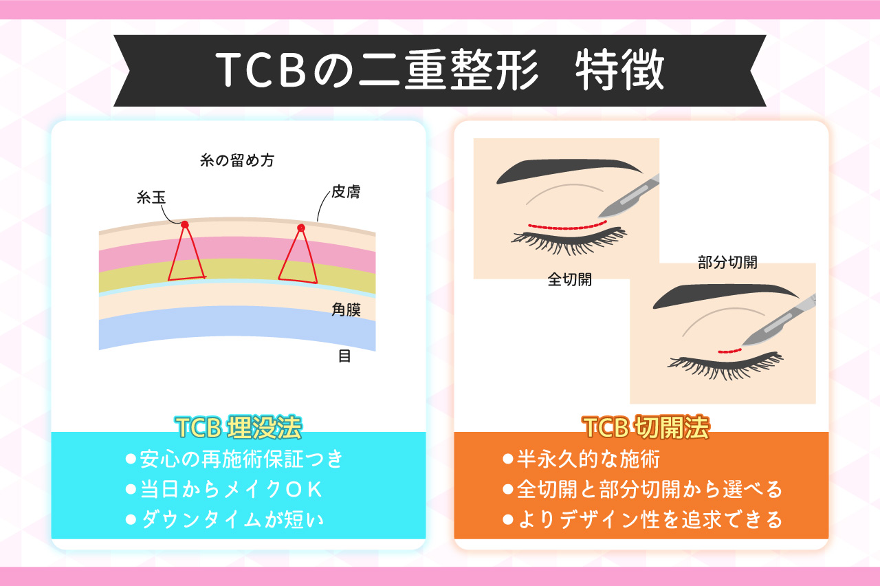 TCB二重整形の特徴・おすすめな人